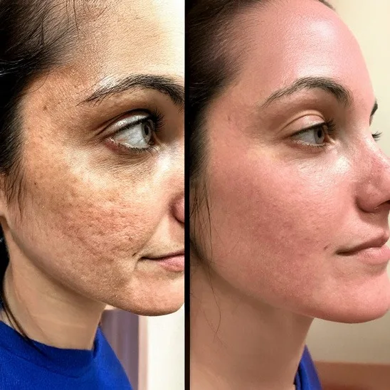 Vorher Nachher CO2 Laser Hauterneuerung und Aknenarben Essen