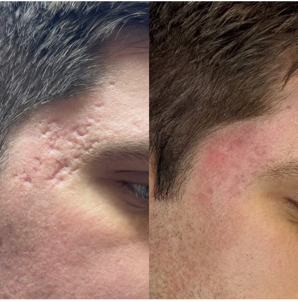 Vorher Nachher CO2 Laser Faltenreduktion Essen