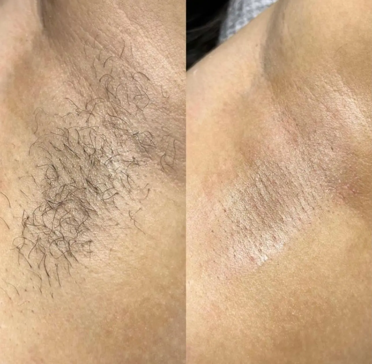 Vorher Nachher Achseln dauerhafte Haarentfernung Diodenlaser Essen