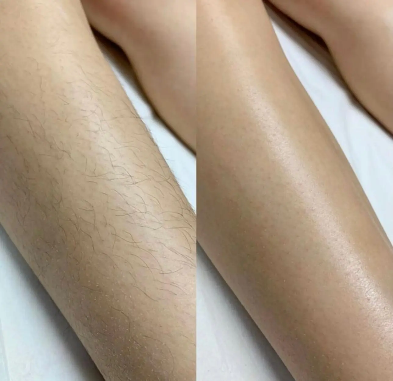 Vorher Nachher Beine dauerhafte Haarentfernung Diodenlaser Essen