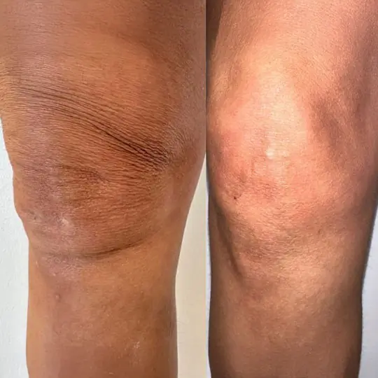 Vorher Nachher RF- und Microneedling Hautbild Essen